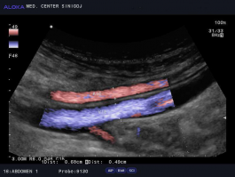 Ultrazvok žil trebuha - arterija in vena iliaka, normalen izvid